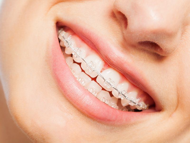 Close-up of clear braces made of tooth-colored ceramic brackets at our office near Kissimmee