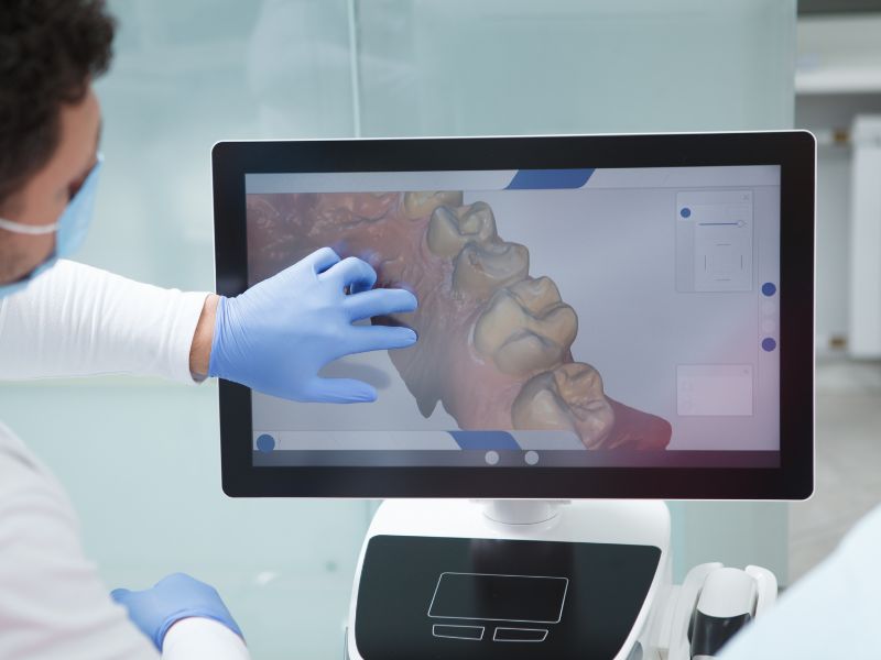 Digital model of the upper jaw used to plan a palate expander for kids near Kissimmee